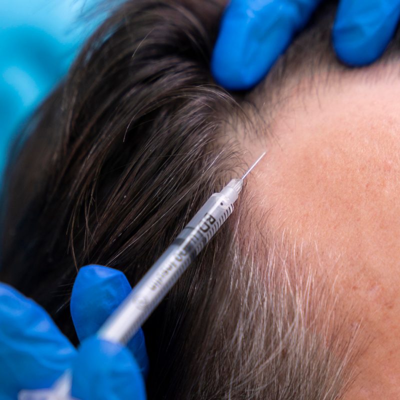 Growth Factor Hair Rejuvenation at The Wellness Co.